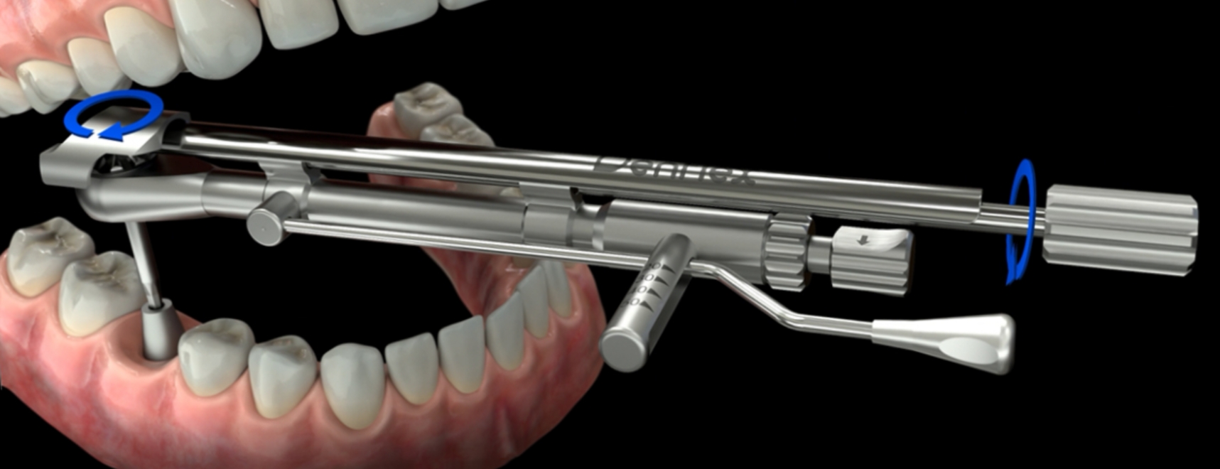 Denflex combined torque wrench workflow from initial tightening to final torque