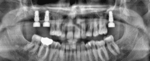 Bilateral sinus lift with immediate implant placement 03