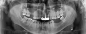 CASE-Lateral window sinus lift-01